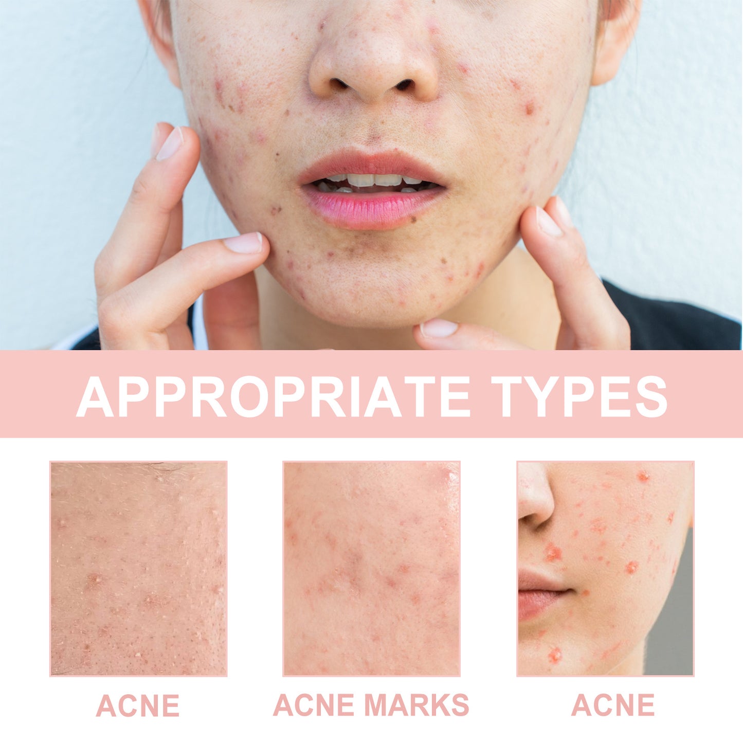 OUHOE ClearSkin – Acne Patches with Microneedles (72 pcs)