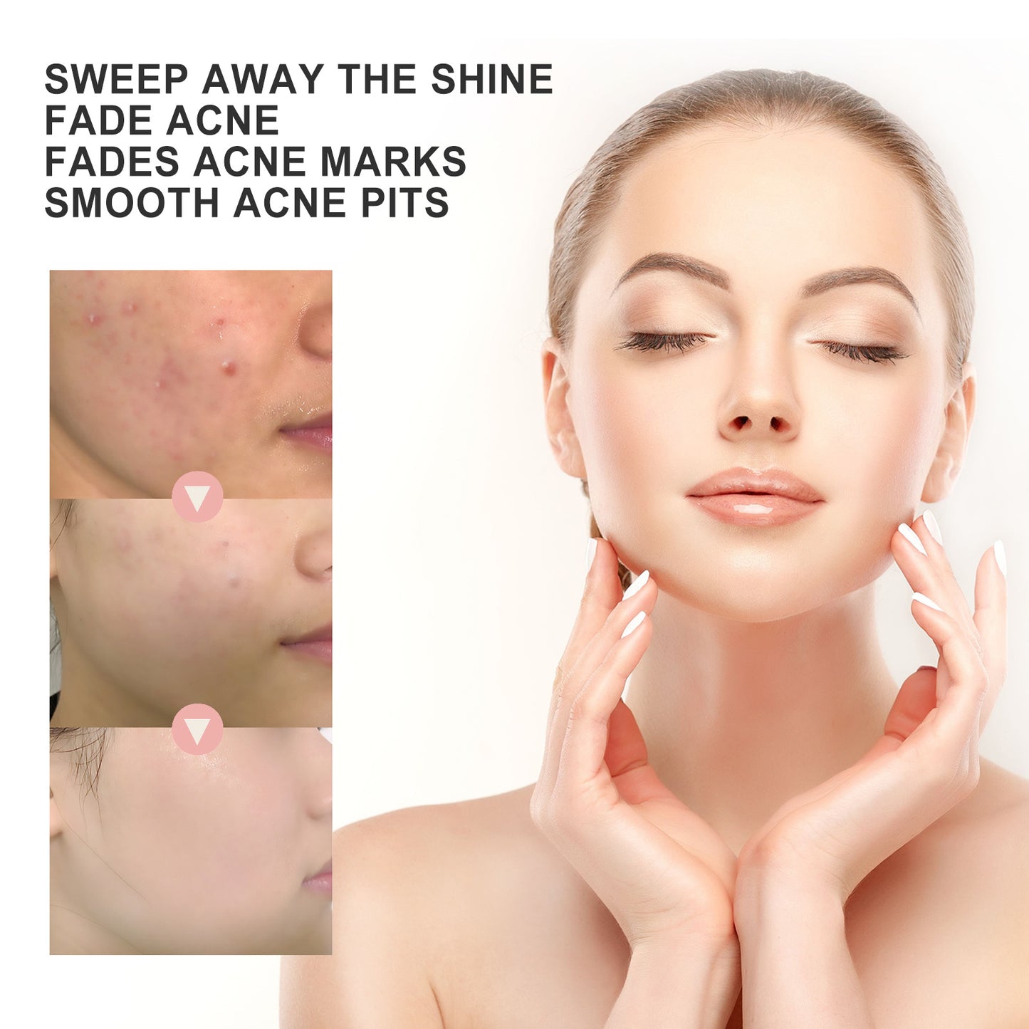 OUHOE ClearSkin – Acne Patches with Microneedles (72 pcs)